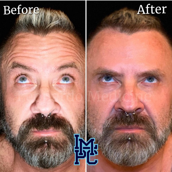 Upper Face Tox treatment 6
