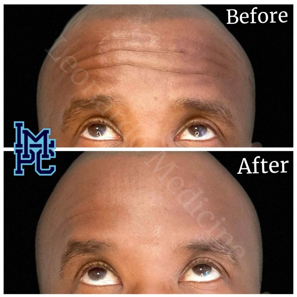 Upper Face Tox treatment 7