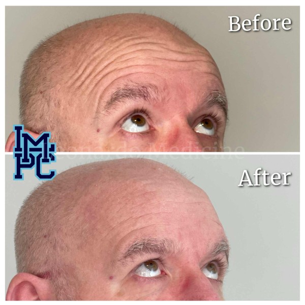 Upper Face Tox treatment 8