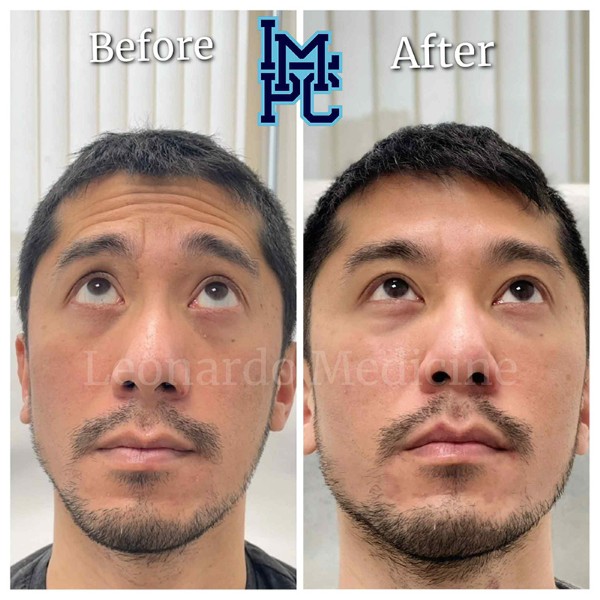 Upper Face Tox treatment 9
