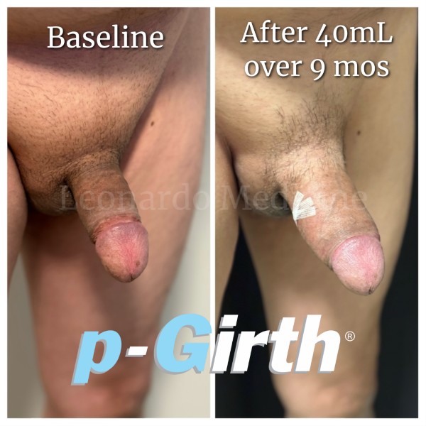 P-Girth® Cut case 1