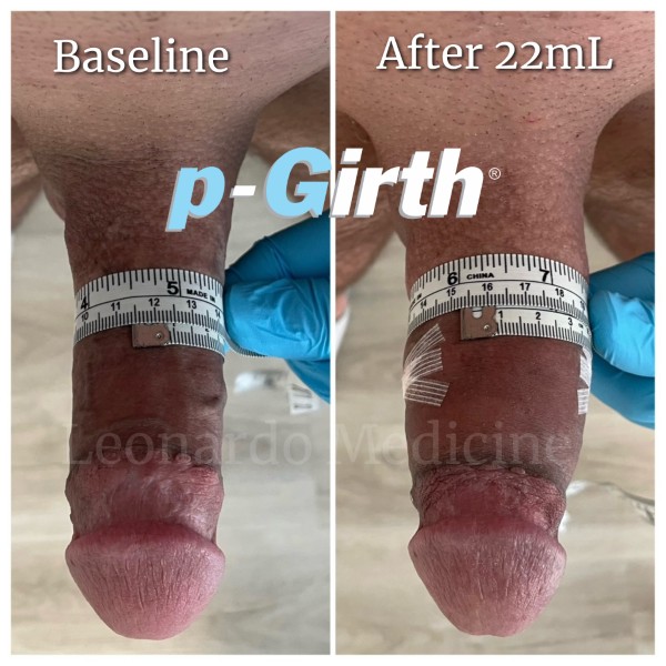 P-Girth® Cut case 10