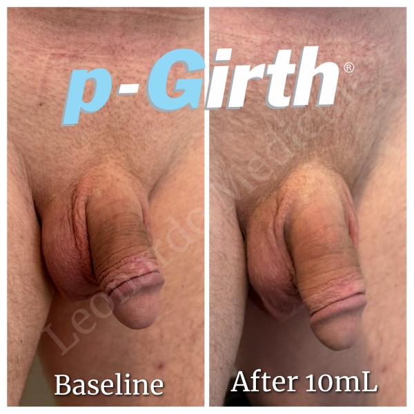 P-Girth® Cut case 12