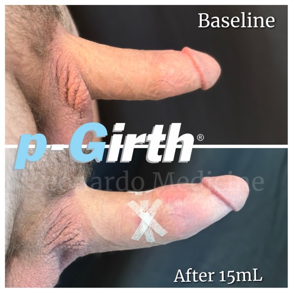 P-Girth® Cut case 13