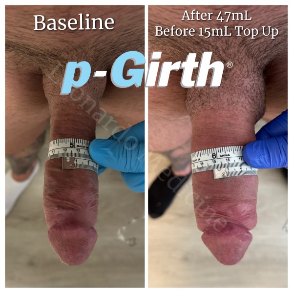 P-Girth® Cut case 14