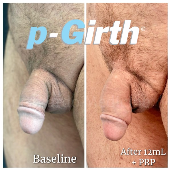 P-Girth® Cut case 16