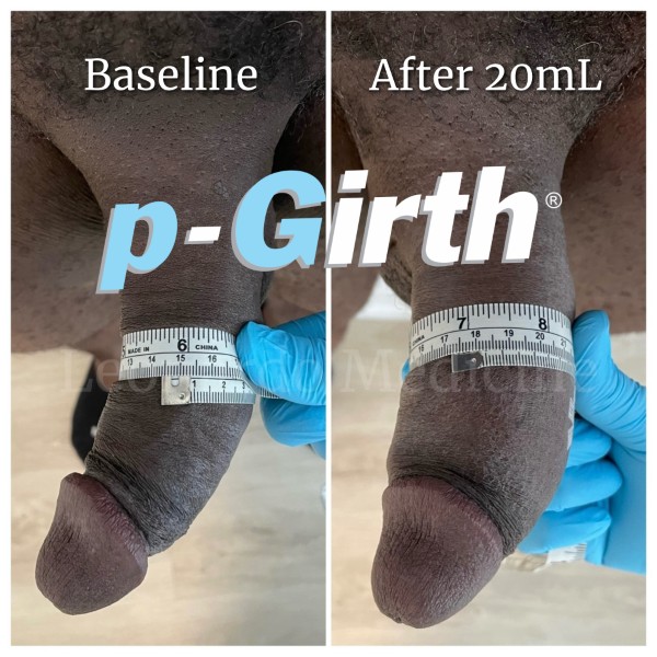 P-Girth® Cut case 19