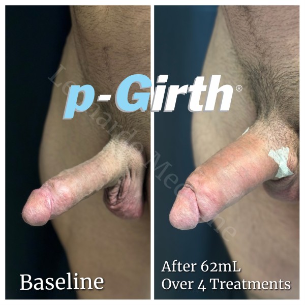 P-Girth® Cut case 22