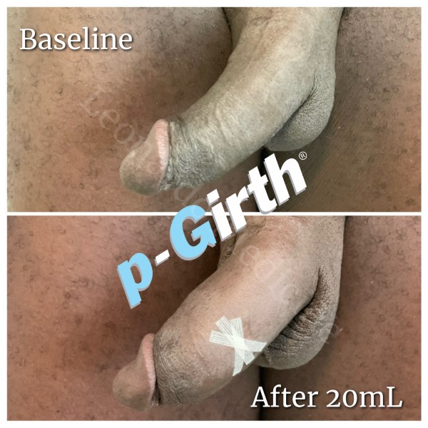 P-Girth® Cut case 24