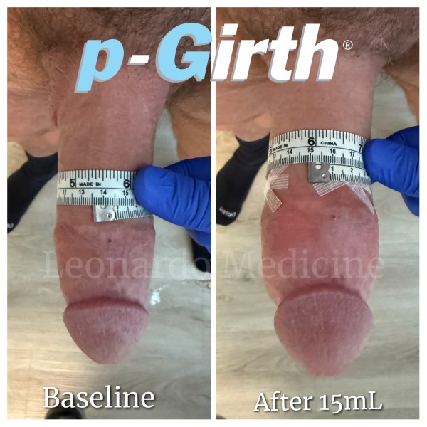 P-Girth® Cut case 25