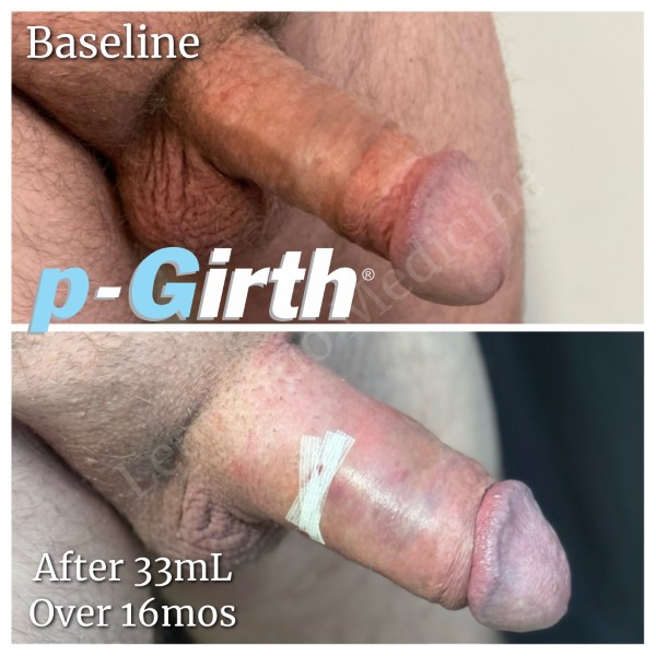 P-Girth® Cut case 27