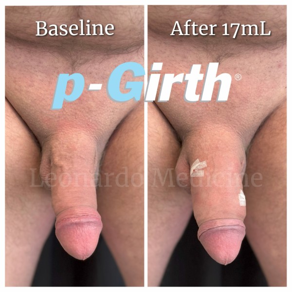 P-Girth® Cut case 28