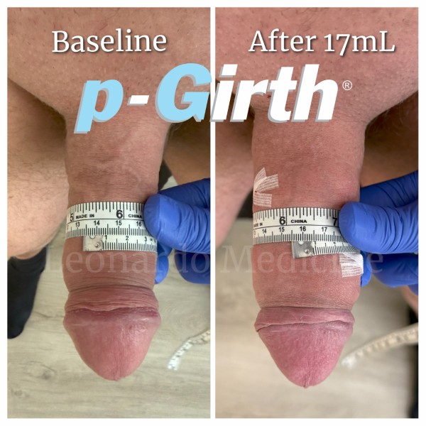 P-Girth® Cut case 29