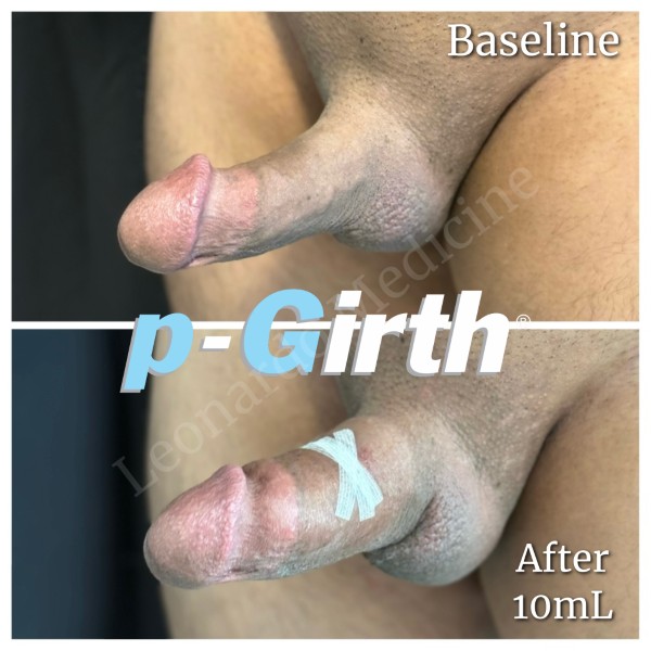 P-Girth® Cut case 3