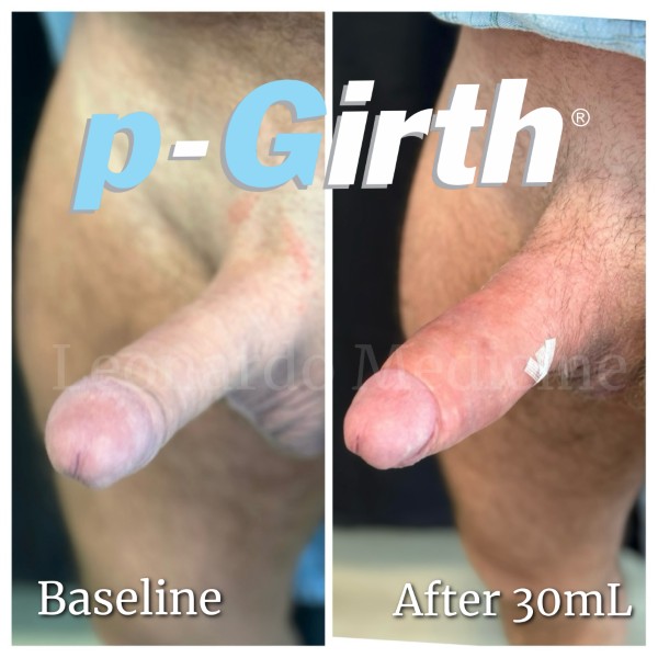 P-Girth® Cut case 32