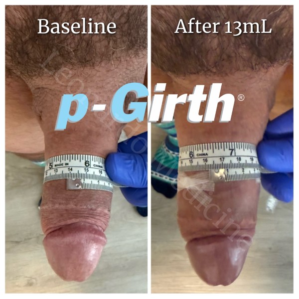 P-Girth® Cut case 34