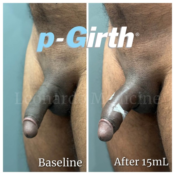 P-Girth® Cut case 42