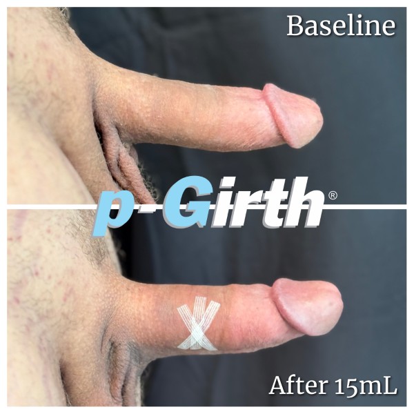 P-Girth® Cut case 6
