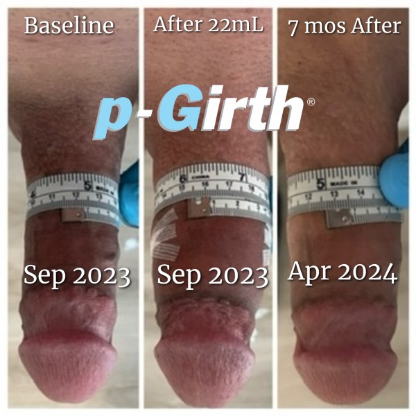 P-Girth Retention case 1