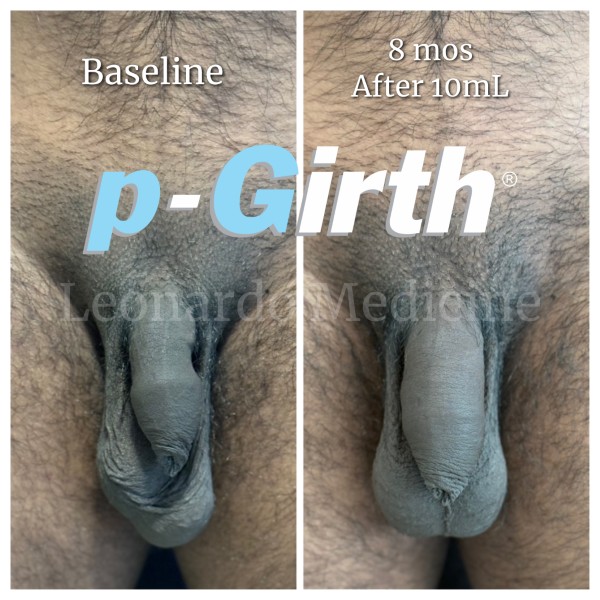 P-Girth Retention case 10