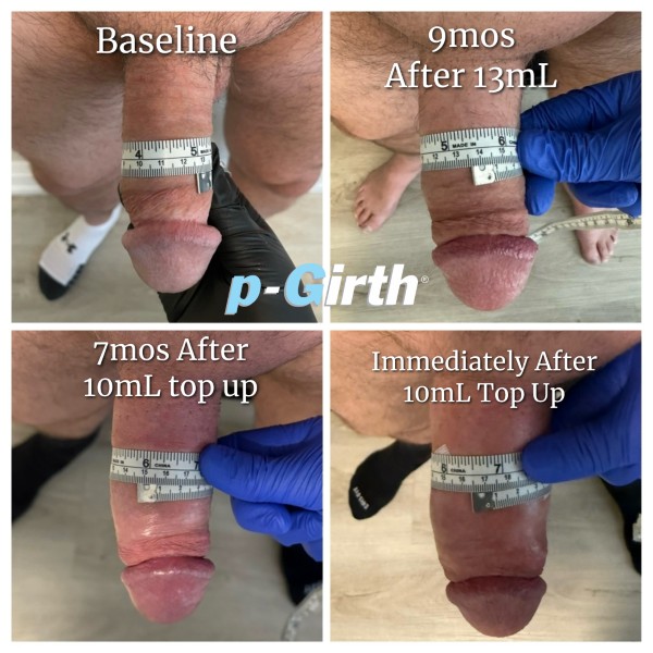 P-Girth Retention case 12