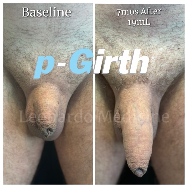 P-Girth Retention case 13