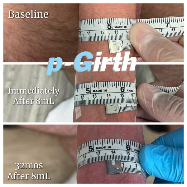 P-Girth Retention case 14