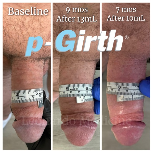 P-Girth Retention case 16