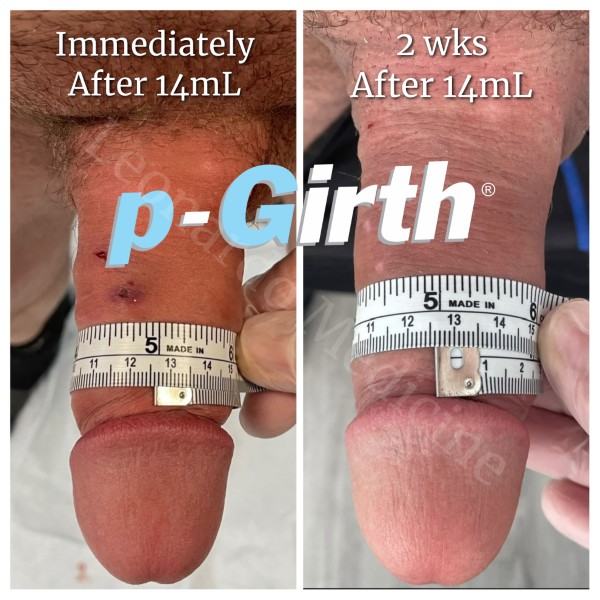 P-Girth Retention case 17