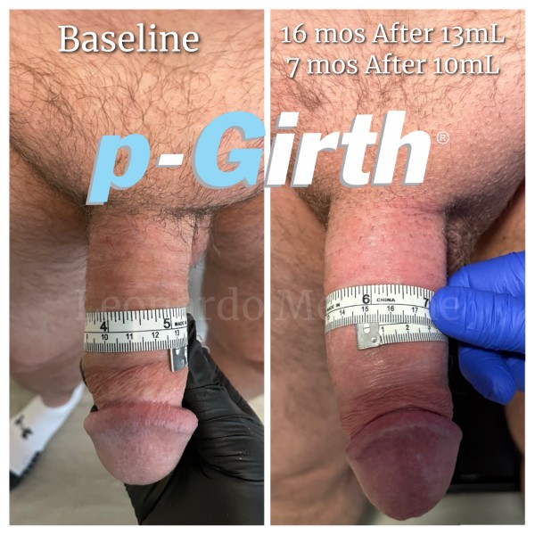 P-Girth Retention case 18