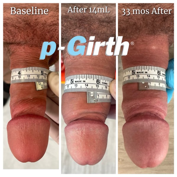 P-Girth Retention case 19