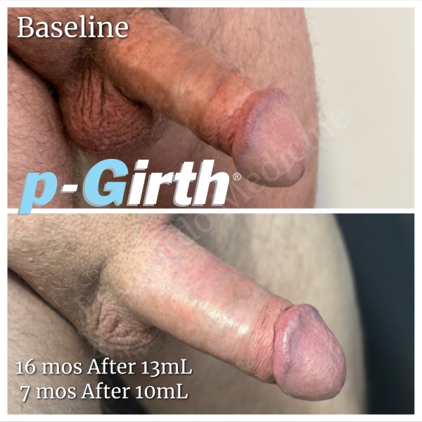 P-Girth Retention case 2