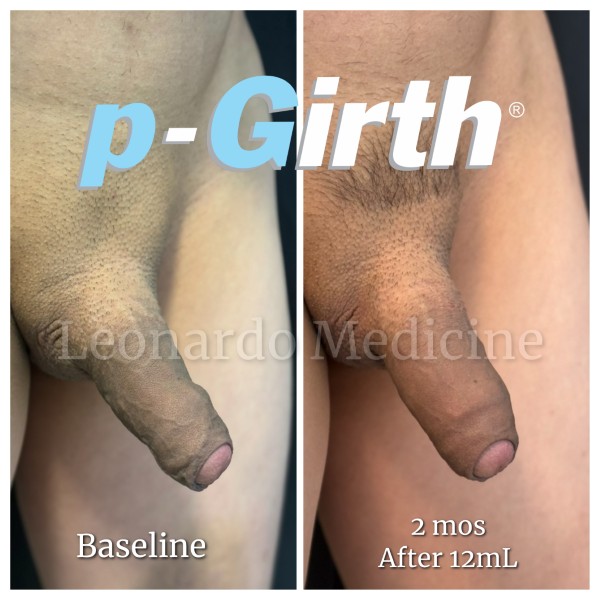 P-Girth Retention case 20