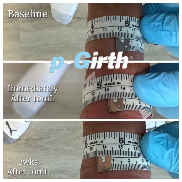 P-Girth Retention case 21