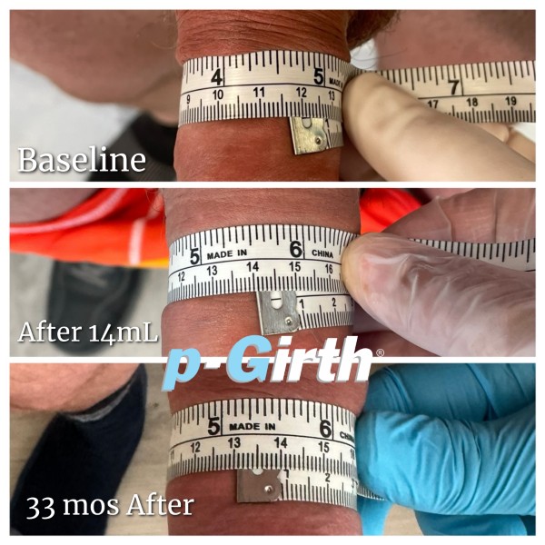 P-Girth Retention case 22