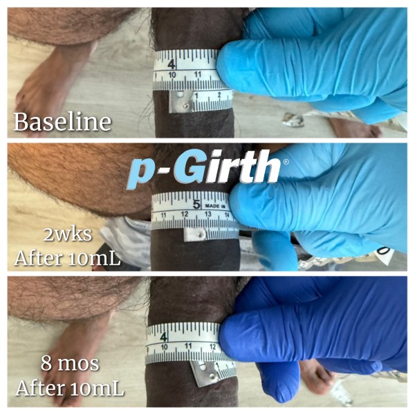 P-Girth Retention case 23