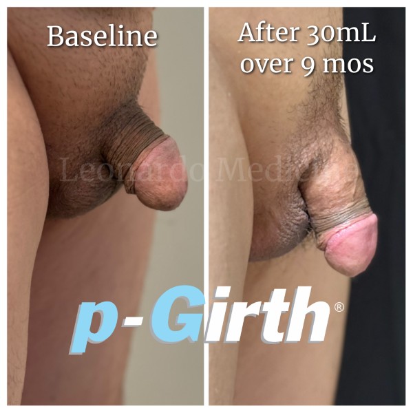 P-Girth Retention case 24