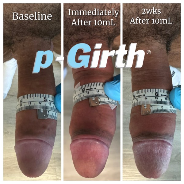 P-Girth Retention case 25