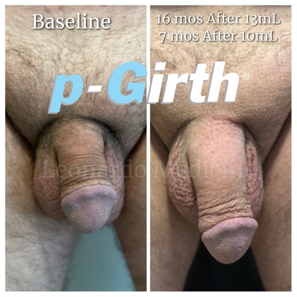 P-Girth Retention case 27