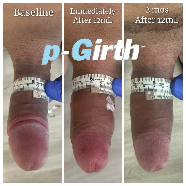 P-Girth Retention case 29