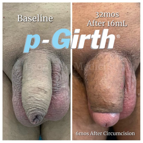 P-Girth Retention case 3