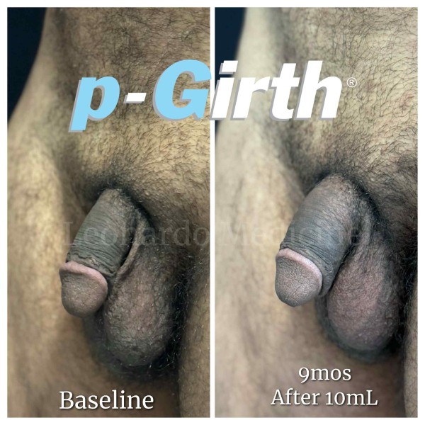 P-Girth Retention case 33