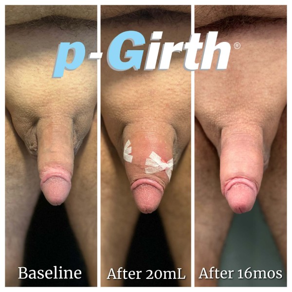 P-Girth Retention case 37