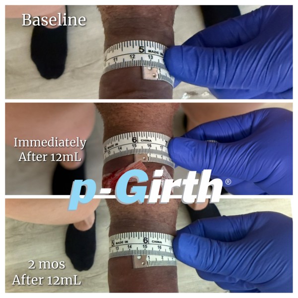 P-Girth Retention case 4