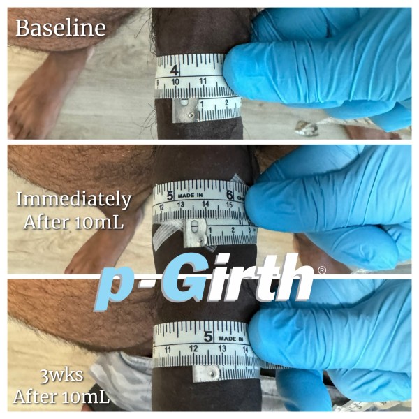 P-Girth Retention case 6
