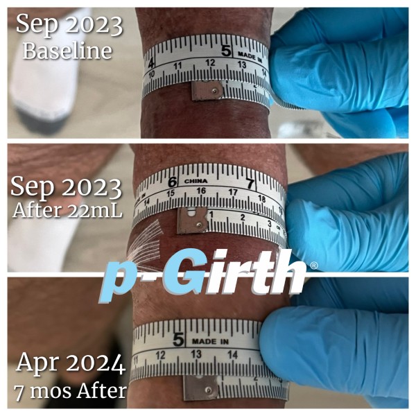 P-Girth Retention case 7
