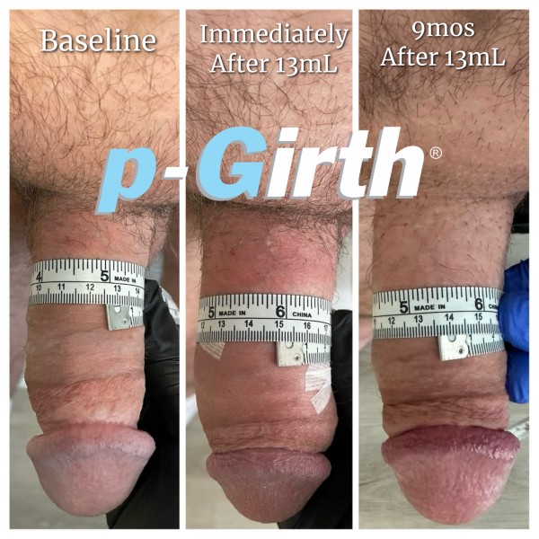 P-Girth Retention case 8