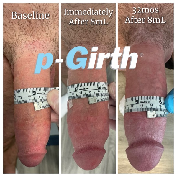 P-Girth Retention case 9