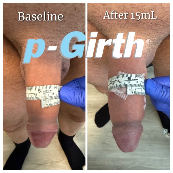 P-Girth® Uncircumcised penis augmentation case 1
