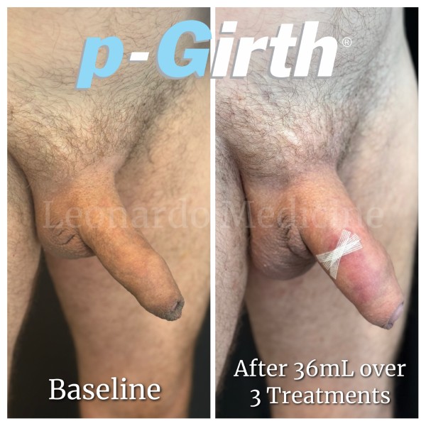 P-Girth® Uncircumcised penis augmentation case 10